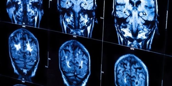 Study links kynurenine pathway to adolescent depression
